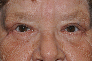 Droopy Upper Eyelid Before & After Results Michigan