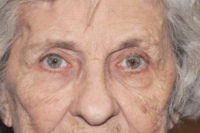 Upper Eyelid Lift or Blepharoplasty