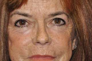 Upper Eyelid Lift or Blepharoplasty