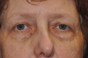 Lower Eyelid Lift Before & After Michigan