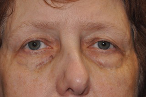 Lower Eyelid Lift or Blepharoplasty