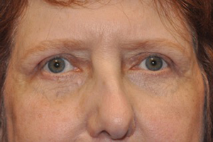 Lower Eyelid Lift or Blepharoplasty