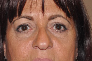 Lower Eyelid Lift or Blepharoplasty