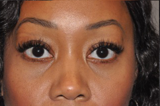 Lower Eyelid Lift or Blepharoplasty