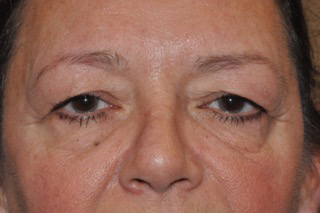 Lower Eyelid Lift or Blepharoplasty