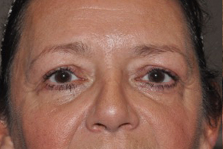 Lower Eyelid Lift or Blepharoplasty