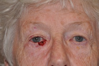 Post Cancer Repair Case 223 Before Photo Post Cancer Repair