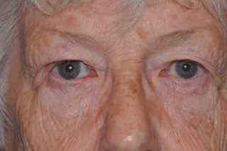 Post Cancer Repair Case 223 After Photo Post Cancer Repair