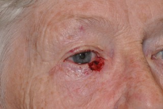 Post Cancer Repair Case 223 Before Photo Post Cancer Repair