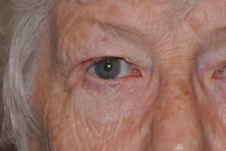 Post Cancer Repair Case 223 After Photo Post Cancer Repair