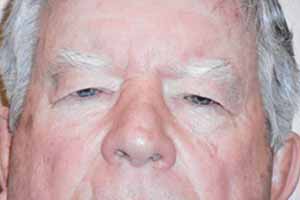 Droopy Upper Eyelids (Ptosis)