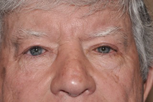 Droopy Upper Eyelids (Ptosis)