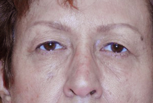 Droopy Upper Eyelids (Ptosis)