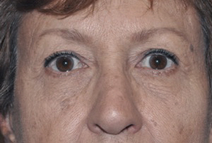 Droopy Upper Eyelids (Ptosis)