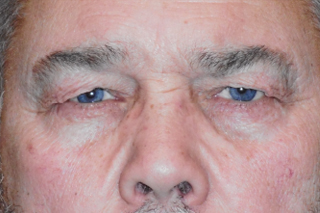 Droopy Upper Eyelids (Ptosis)