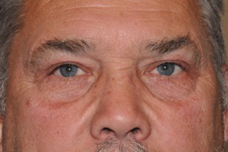 Droopy Upper Eyelids (Ptosis)