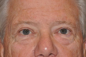 Droopy Upper Eyelids (Ptosis)