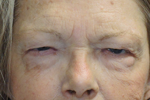 Droopy Upper Eyelids (Ptosis)