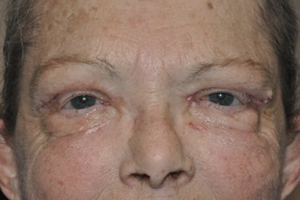 Droopy Upper Eyelids (Ptosis)