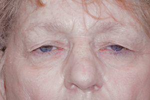 Droopy Upper Eyelids (Ptosis)