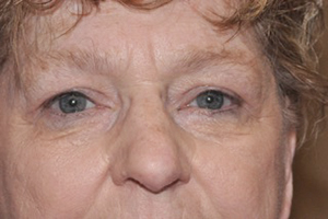 Droopy Upper Eyelids (Ptosis)