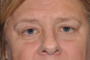 Droopy Upper Eyelids (Ptosis)