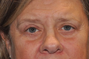 Droopy Upper Eyelids (Ptosis)