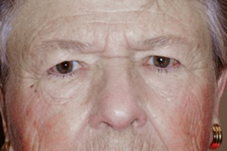 Droopy Upper Eyelids (Ptosis)