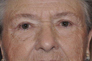 Droopy Upper Eyelids (Ptosis)