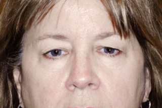 Droopy Upper Eyelids (Ptosis)