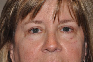 Droopy Upper Eyelids (Ptosis)