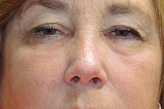 Droopy Upper Eyelids (Ptosis)