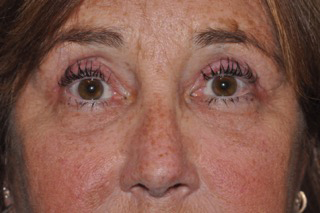 Droopy Upper Eyelids (Ptosis)