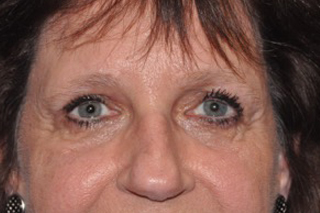 Eyebrow Lift or Forehead Lift
