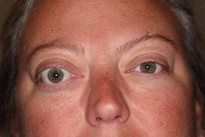Orbital Disorders