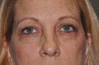 Lower Eyelid Lift or Blepharoplasty