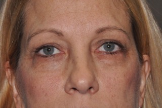 Lower Eyelid Lift or Blepharoplasty