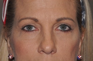 Lower Eyelid Lift or Blepharoplasty