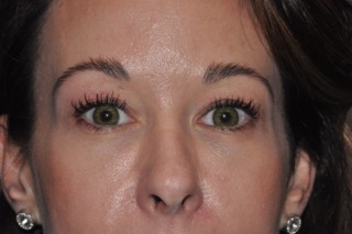 Upper Eyelid Lift or Blepharoplasty