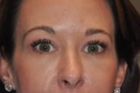 Upper Eyelid Lift or Blepharoplasty