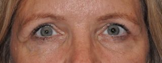 Upper Eyelid Lift or Blepharoplasty