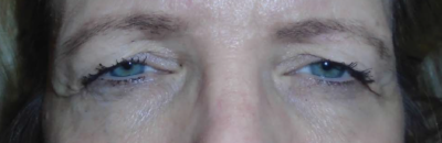 Upper Eyelid Lift or Blepharoplasty