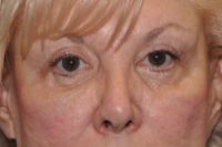 Upper Eyelid Lift or Blepharoplasty