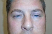 Droopy Upper Eyelids (Ptosis)