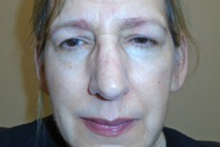 Droopy Upper Eyelids (Ptosis)