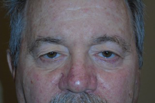 Droopy Upper Eyelids (Ptosis)