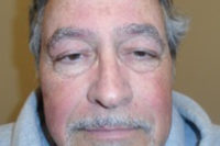 Droopy Upper Eyelids (Ptosis)