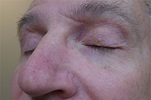 Eyelid Lesion