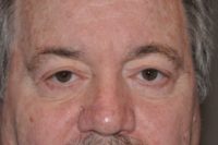 Droopy Upper Eyelids (Ptosis)