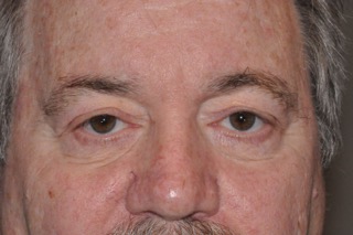 Droopy Upper Eyelids (Ptosis)